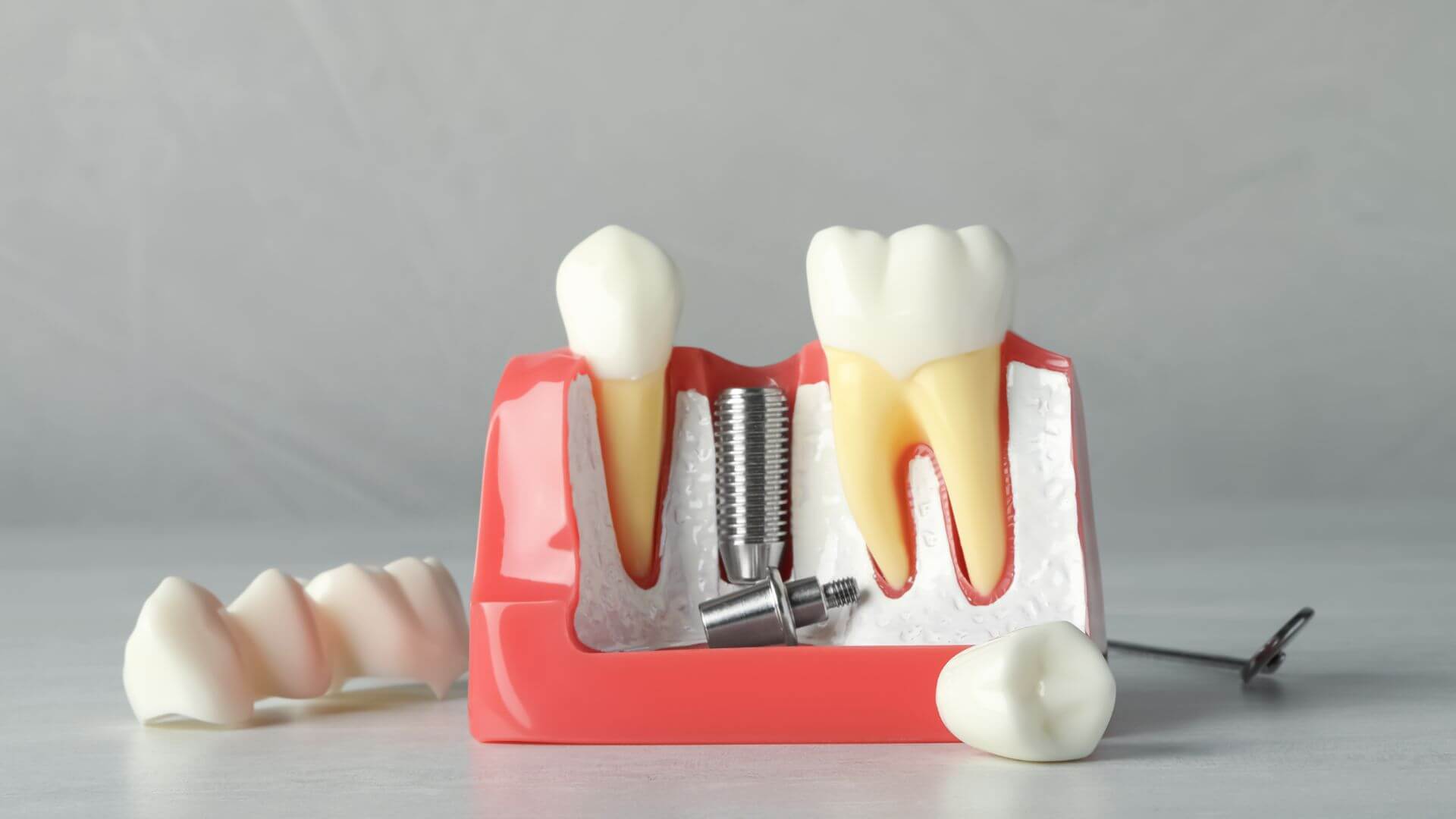 What To Know Before You Decide Getting Dental Implants
