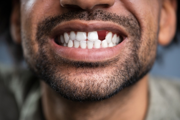 what are the best options to replace missing teeth