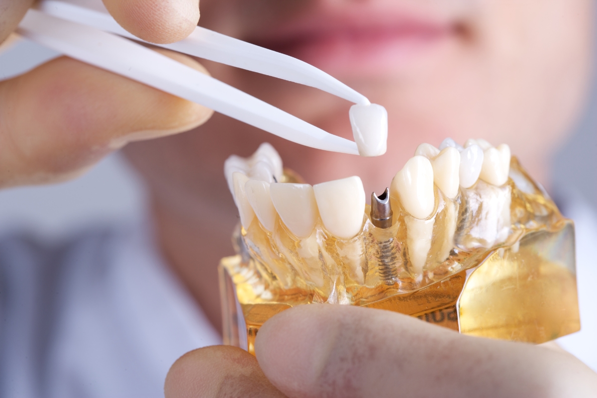 dental implants in Irvine