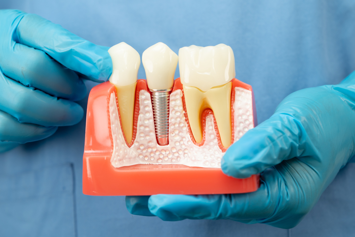root canal treatment Irvine