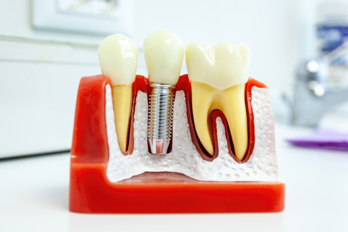 dental implants in Irvine
